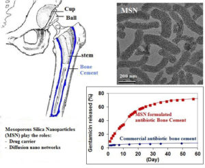 nanostructured material formulated acrylic bone cements enhanced-drug release-medicine innovates
