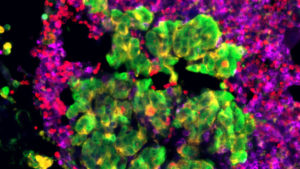 Onalespib Blocks mRNA Splicing of Androgen Receptor Variant 7 in Prostate Cancer (Medicine Innovates)