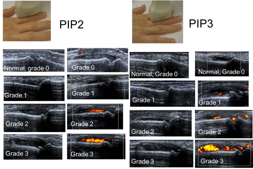 Ultrasound of the hand is sufficient to detect subclinical inflammation