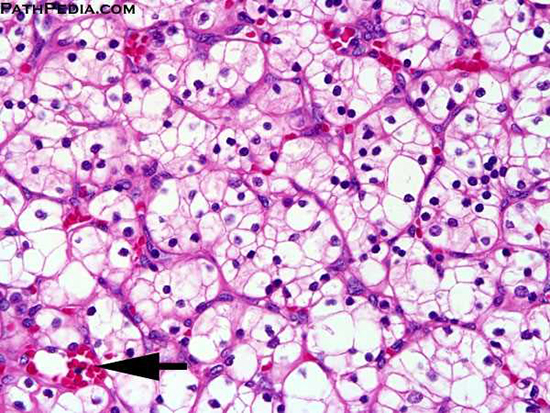 Improved prediction of High ISUP Grade Clear Cell Renal Cell Carcinoma - Medicine Innovates