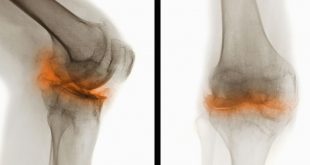 Catabolism of Fibromodulin Developmental Rudiment and Pathologic Articular Cartilage-Medicine Innovates