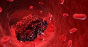 Senescent Cells Promote Blood Clotting - Medicine Innovates