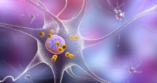 Patients with Young-onset Parkinson’s disease are born with dysfunctional brain cells - Medicine Innovates