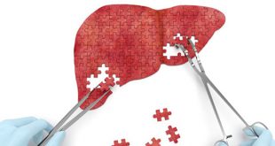 Targeting miR-144 a promising therapeutic strategy for the treatment of liver diseases in obese patients - Medicine Innovates