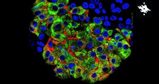 New Genetic Mechanism Identified in Neonatal Diabetes - Medicine Innovates