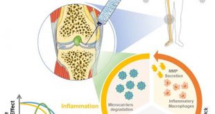 Bioresponsive microspheres for on-demand delivery of anti-inflammatory cytokines for articular cartilage repair - Medicine Innovates
