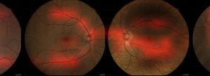 Algorithm detects early vascular disease using photos of the eye - Medicine Innovates