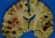 Attack on the Cerebral Vasculature with Anti-Amyloid Immunotherapy in Alzheimer's Disease: A Pathological Perspective - Medicine Innovates