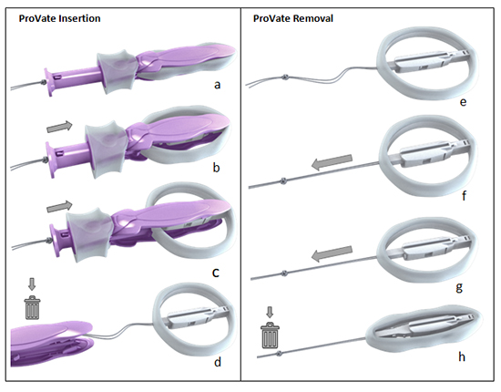 Empowering Women with Pelvic Organ Prolapse: Introducing ProVate, the Revolutionary Self-Insertable and Disposable Vaginal Support Device - Medicine Innovates