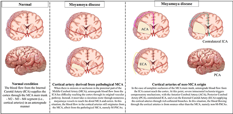 Vascular Mysteries in Moyamoya Disease: Innovative Study on Parasylvian Cortical Arterial Hemodynamics - Medicine Innovates