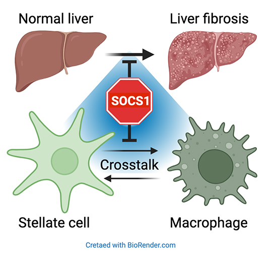 SOCS1 Regulation of Hepatic Stellate Cell Activation: Implications for Liver Fibrosis and Hepatocellular Carcinoma Development - Medicine Innovates