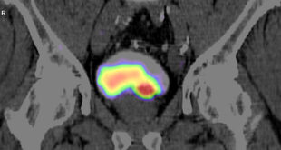 Enhanced Diagnostic Accuracy of Tc-PSMA SPECT/CT vs. mpMRI in Prostate Cancer Staging and Relapse Detection - Medicine Innovates