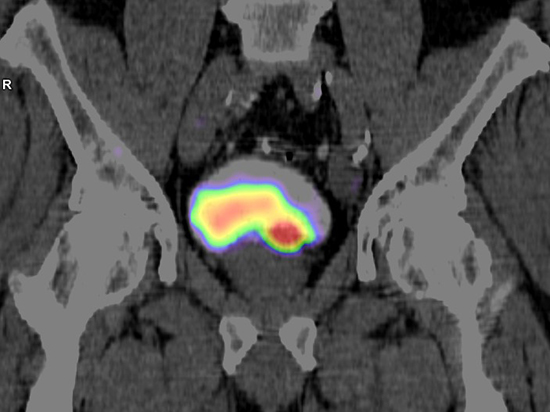 Enhanced Diagnostic Accuracy of Tc-PSMA SPECT/CT vs. mpMRI in Prostate Cancer Staging and Relapse Detection - Medicine Innovates