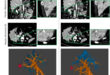 Exploiting Transcription-Replication Collisions to Treat Pancreatic Cancer: AOH1996 as a Precision Vulnerability Drug - Medicine Innovates