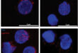 Lipid-Induced Paralysis of NK Cells in Ovarian Cancer Ascites: A Metabolic Immune Checkpoint - Medicine Innovates